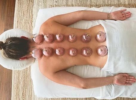 Person lying on stomach with cupping therapy on their back.